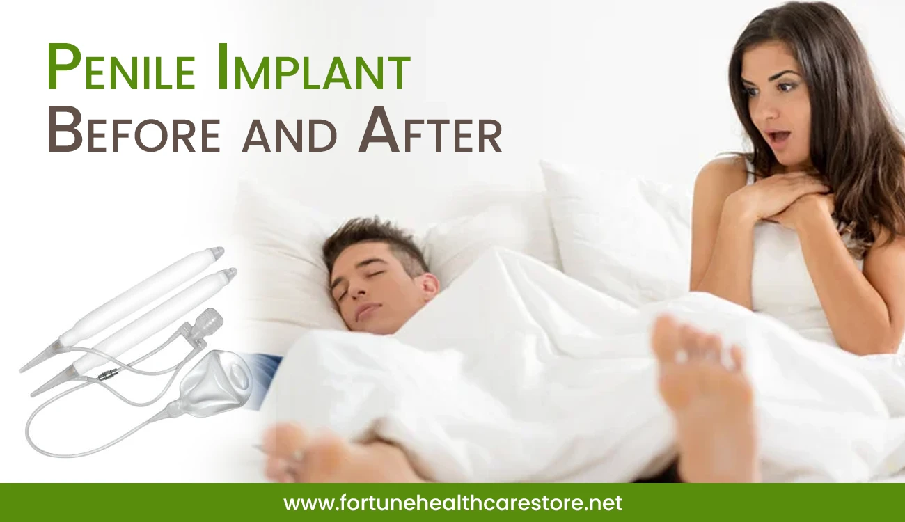 Penile Implant Before and After